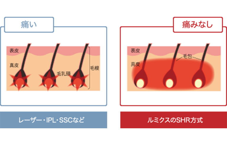 脱毛と痛みの関係